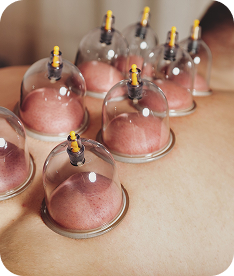Cupping Therapy